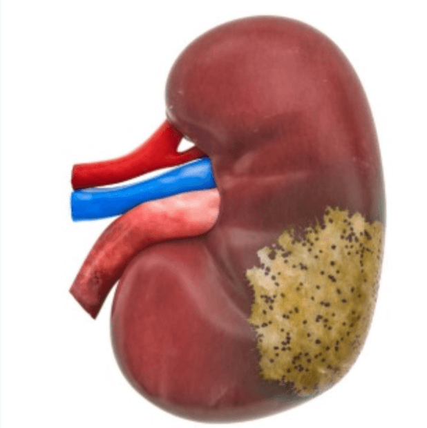 Chronic Kidney Disease